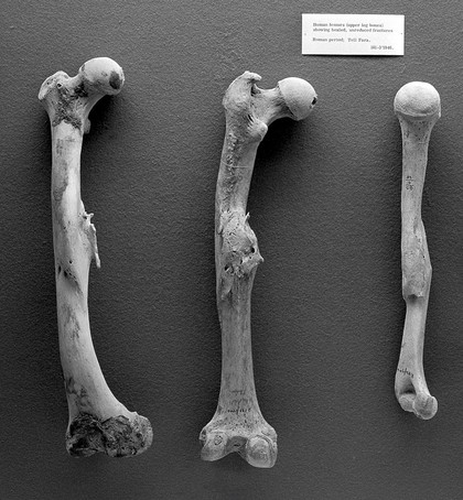 Paleopathology: Human femurs from Roman period, Tell Fara