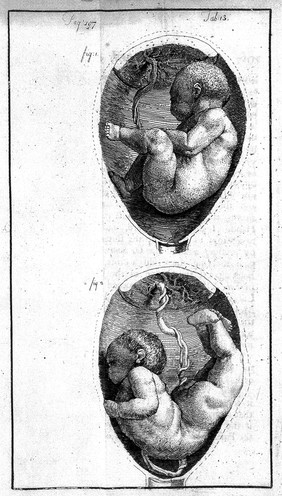An essay towards a complete new system of midwifry, theoretical and practical. Together with the descriptions, causes and methods of removing, or relieving the disorders peculiar to pregnant ... women, and new-born infants / [John Burton].