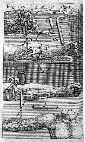 Engravings of techniques of blood transfusion from man to animal.