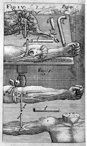 view Engravings of techniques of blood transfusion from man to animal.