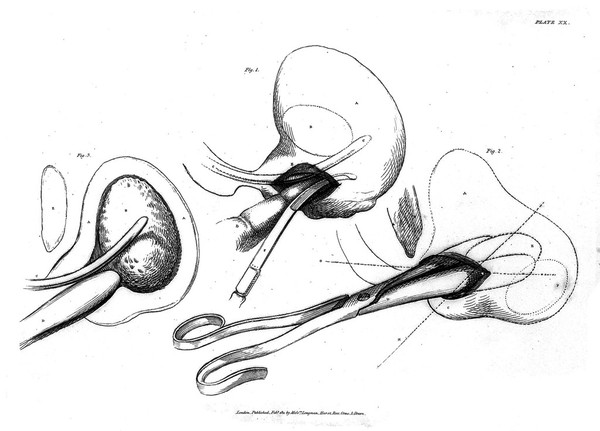 plate xx "Illustrations of the Great Operations of Surgery", 1820