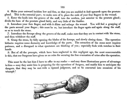 Illustrations of the great operations of surgery, trepan, hernia, amputation, aneurism, and lithotomy / [Sir Charles Bell].