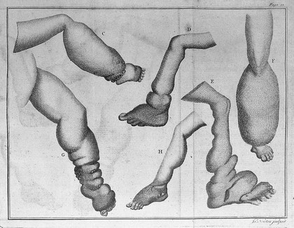 A treatise on the glandular disease of Barbadoes, proving it to be seated in the lymphatic system / by James Hendy.