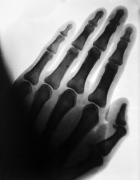 X-ray of a hand. Photograph, ca. 1900 (?).