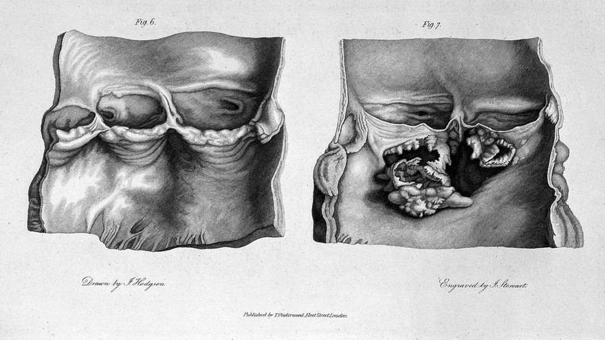 Engravings, intended to illustrate some of the diseases of arteries. Accompanied with explanations / [Joseph Hodgson].