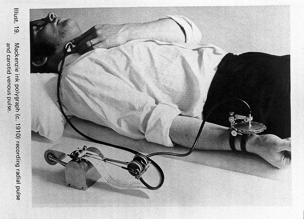 Sir J. Mackenzie's ink polygraph (c.1910) recording radial pulse and carotid venous pulse