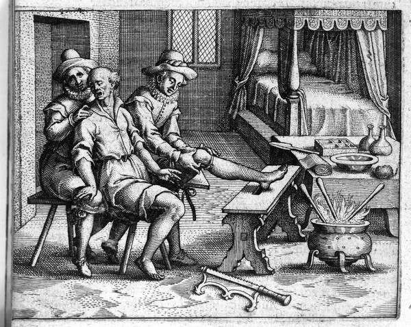 Amputation scene, "De gangraena et sphacelo" Fabricius Hildanus