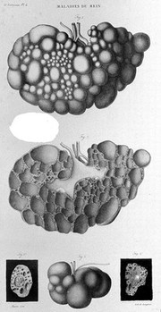 Anatomie pathologique du corps humain, ou descriptions ... des diverses altérations morbides dont le corps humain est susceptible / [J. Cruveilhier].