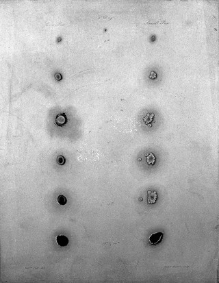 Engraving of daily development of cow-pox and smallpox.