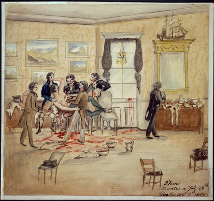 A surgical operation to remove a malignant tumour from a man's left breast and armpit in a Dublin drawing room, 1817. Watercolour, ca 1913, after a watercolour, 1817.