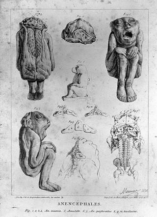 Malformed foetuses and skeletons with part of the brain missing. Lithograph by Meunier, 1826.