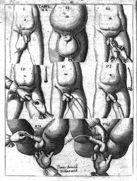 Armamentarium chirurgicum bipartitum / studioq́; & operâ D. Joannis Sculteti ... reformatum, correctum & auctum. Cum LVI. tabulis, sive figuris aeneis novis accuratissimis. Ut & tribus indicibus absolutissimis, instrumentorum scilicet, observationum, et rerum notabilium.