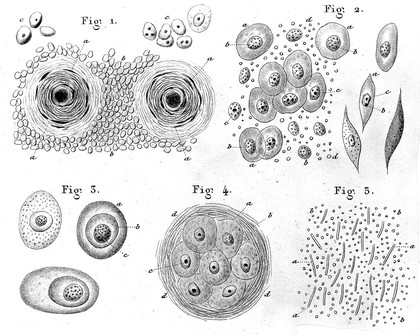 Physiologie pathologique ou recherches cliniques, expérimentales et microsopiques sur l'inflammation, la tuberculisation, les tumeurs, la formation du cal, etc / par H. Herbert, accompagné d'un atlas de vingt-deux planches gravées.