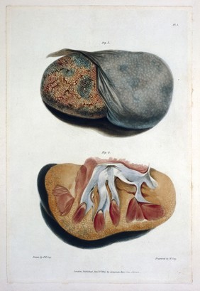 Reports of medical cases, selected with a view of illustrating the symptoms and cure of diseases by a reference to morbid anatomy / By Richard Bright.