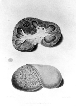 Reports of medical cases, selected with a view of illustrating the symptoms and cure of diseases by a reference to morbid anatomy / By Richard Bright.