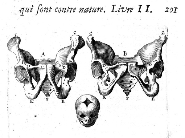 Des maladies des femmes grosses et accouchées. Avec la bonne et veritable méthode de les bien aider en leurs accouchemens naturels, & les moyens de remedier à tous ceux qui sont contre-nature, & aux indispositions des enfans nouveau-nés: ensemble une tres-exacte description de toutes les parties de la femme qui sont destinées à la generation ... / composé par François Mauriceau maistre chirurgien iuré à Paris.