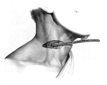 Traité complet de l'anatomie de l'homme comprenant la médecine opératoire ... : avec planches lithographiées ... / par N.H. Jacob.