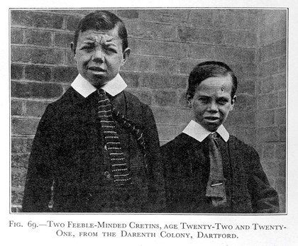 "Two Cretins" from Heredity in Man, R. Ruggles Gates, 1929