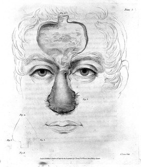 An account of two successful operations for restoring a lost nose from the integuments of the forehead in the cases of two officers of His Majesty's Army; to which are prefixed historical and physiological remarks on the nasal operation; including descriptions of the Indian and Italian methods / [J.C. Carpue].