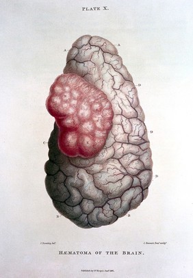 The morbid anatomy of the human brain. Illustrated by coloured engravings of the most frequent and important organic diseases to which that viscus is subject / [Robert Hooper].