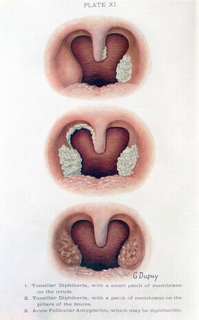 The diseases of infancy and childhood : designed for the use of students and practitioners of medicine / by Henry Koplik.