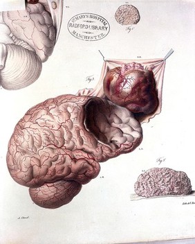 Anatomie pathologique du corps humain, ou descriptions ... des diverses altérations morbides dont le corps humain est susceptible / [J. Cruveilhier].