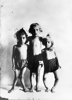 Photograph: three children with rickets