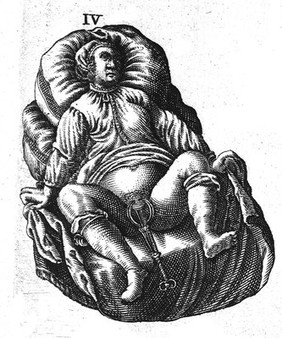 Use of vaginal speculum, circa 1657