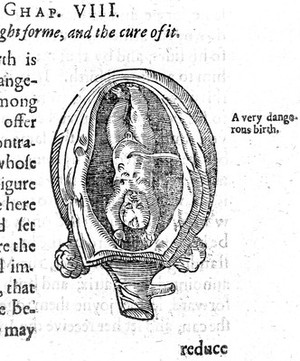 view Woodcut of foetus in utero