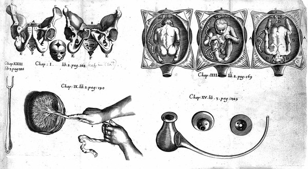 The accomplisht midwife, treating of the diseases of women with child, and in child-bed. As also, the best directions how to help them in natural and unnatural labours. With fit remedies for ... indispositions of new-born babes ... / Translated, and enlarged with ... marginal-notes, by Hugh Chamberlen.