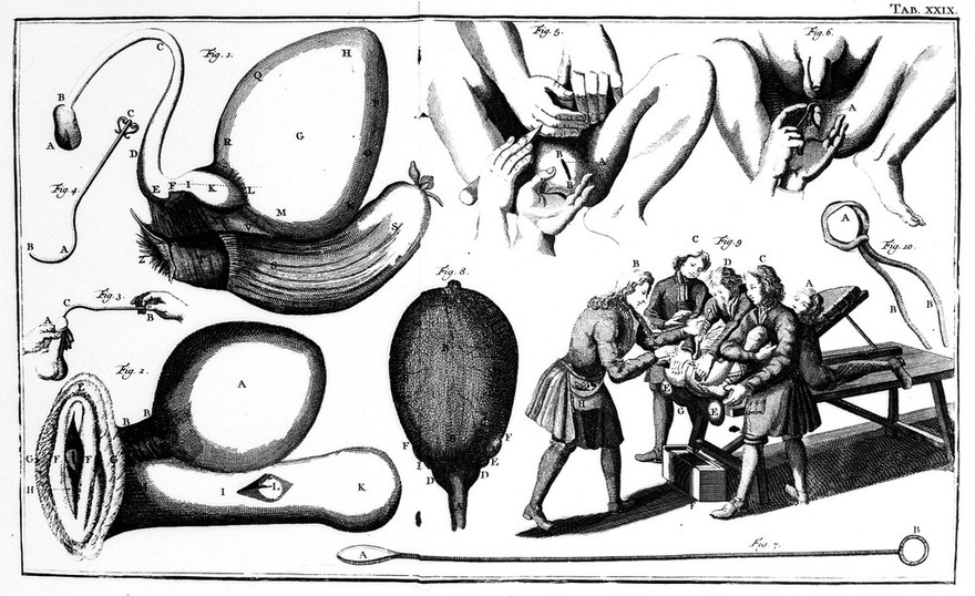 D. Lavrentii Heisteri sereniss. Brunsiucens. ... Institvtiones chirvrgicae in qvibvs qvicqvid ad rem chirvrgicam pertinet, optima et novissima ratione pertractatvr atque in tabulis multis aeneis praestantissima ac maxime necessaria instrumenta itemque artificia, sive encheirises praecipuae et vincturae chirurgicae repraesentantur. Opvs triginta annorvm, nunc demum, post aliquot editiones Germanica lingua evulgatas, in exterorum gratium Latine publicatum / [Lorenz Heister].