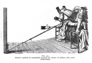 view Delore's method of mechanical traction with pullies and cords