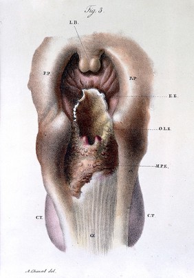 Anatomie pathologique du corps humain, ou descriptions ... des diverses altérations morbides dont le corps humain est susceptible / [J. Cruveilhier].