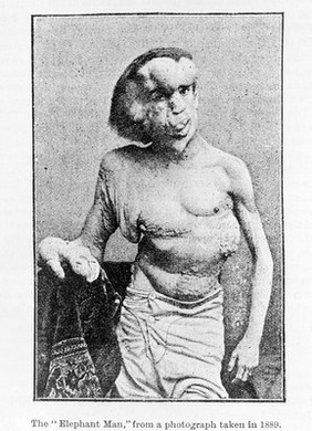 Photograph of the 'Elephant Man' from BMJ April 1890