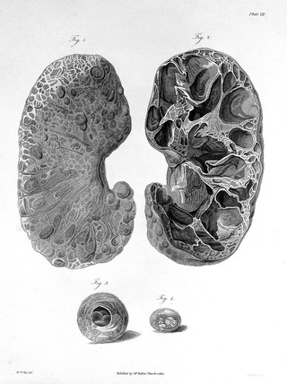 A series of engravings, accompanied with explanations, which are intended to illustrate the morbid anatomy of some of the most important parts of the human body / [Matthew Baillie].