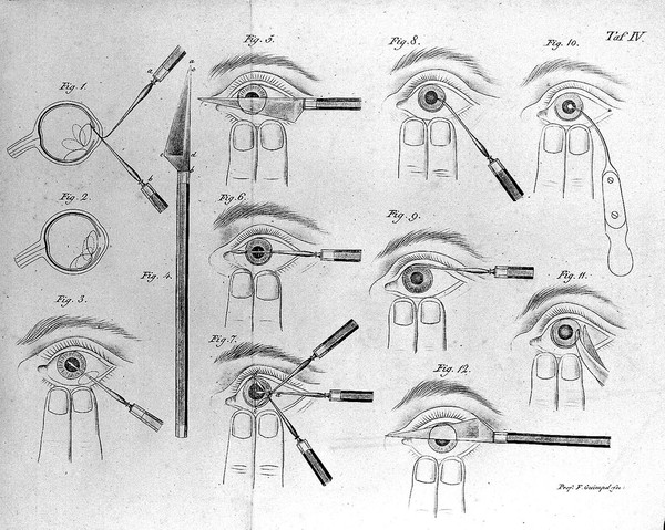 Die Lehre von den Augenoperationen. Ein Handbuch für angehende Aerzte und Wundärzte ... / [Johann Christian Jüngken].