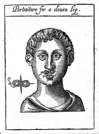 A discourse of the whole art of chyrurgerie. Wherein is exactly set downe the definition, causes, accidents, prognostications, and cures of all sorts of diseases ... Wherunto is added the rule of making remedies which chirurgions doe commonly use: with the Presages of divine Hyppocrates / [Peter Lowe].