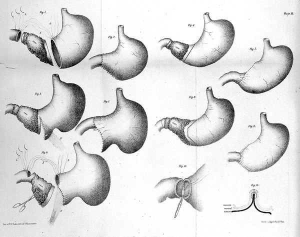 Clinical surgery : extracts from the reports of surgical practice between the years 1860-1876 / by T. Billroth ; translated from the original, and edited, with annotations, by C.T. Dent.