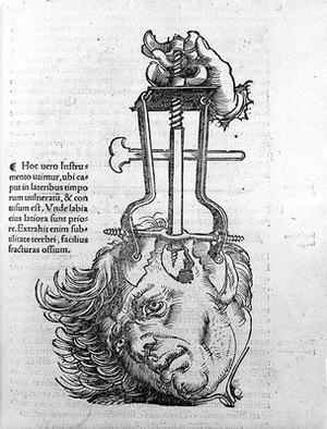 view Trepanation, from, 'Chirurgia'