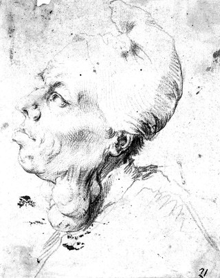 A man with goitre. Chalk drawing by J. de Ribera.