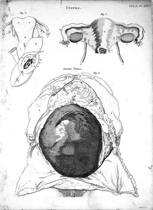 view Uterus and gravid uterus from Burrowes, Modern Encyclopaedia
