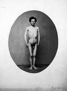 A standing young man, naked and viewed from the front in full length; he appears emaciated. Photograph by L. Haase after H.W. Berend, c. 1865.