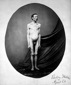 A naked man, standing; despite his emaciation, his abdomen is swollen. Photograph by L. Haase after H.W. Berend, 1864.