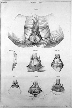Demonstrationum anatomico-pathologicarum liber primus, continens brachii humani fabricam et morbos / [Petrus Camper].