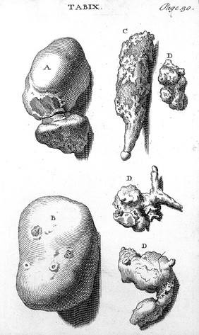 A treatise on the high operation for the stone ... / By William Cheselden.