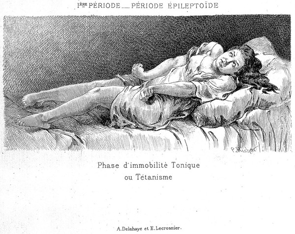 Études cliniques sur l'hystéro-épilepsie ou grande hystérie / par Paul Richer ; précédé d'une lettre-préface de J.-M. Charcot.