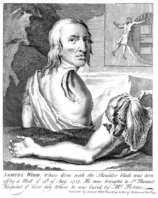 Samuel Wood, a man whose shoulder and arm were torn off in an accident at a mill. Engraving, 1737.