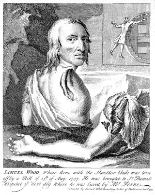 Samuel Wood, a man whose shoulder and arm were torn off in an accident at a mill. Engraving, 1737.