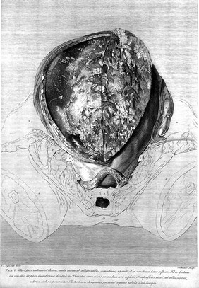 Anatomia uteri humani gravidi tabulis illustrata ... The anatomy of the human gravid uteris exhibited in figures / [William Hunter].