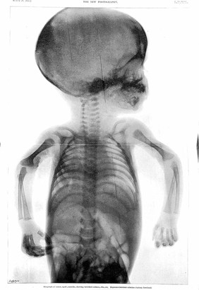 S. Rowland: skiagraph of 3 months old infant